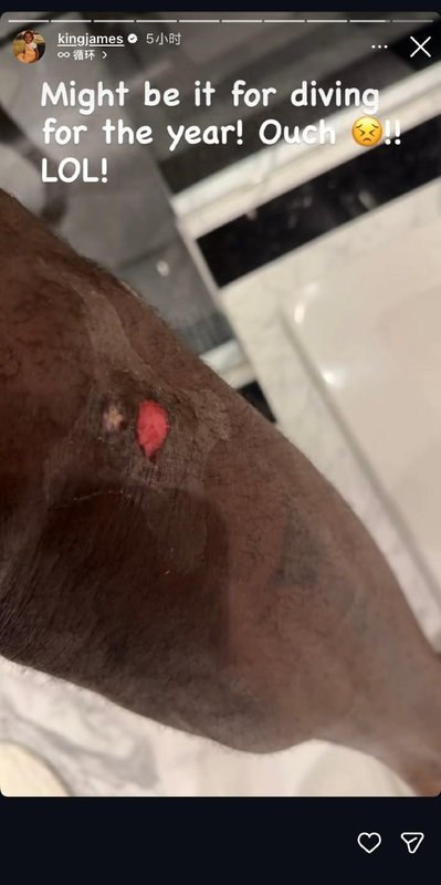  詹姆斯腿部伤口曝光，那次飞身救球堪称经典；疼痛难忍却换来胜利喜悦。 体育新闻